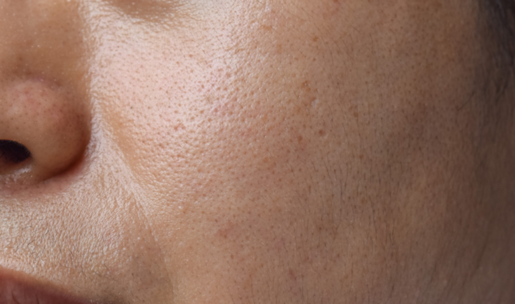 넓어진 모공 이미지