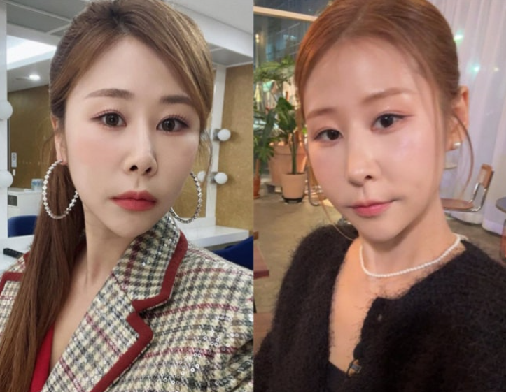 박세미 코 재수술 전후