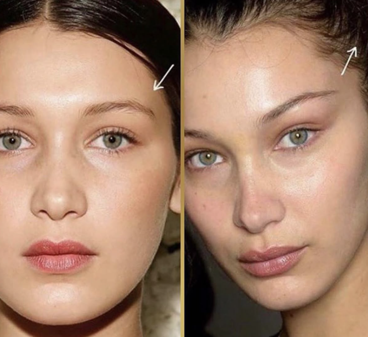 외국모델 얼굴형 관리 전,후