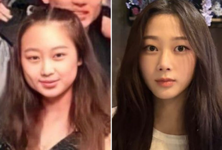 지젤 얼굴형 관리 전,후