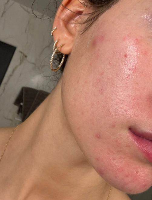 압출로 빨갛게 된 여드름흉터