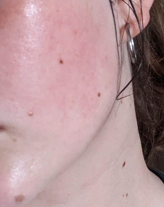 홍조를 띈 얼굴 클로즈업